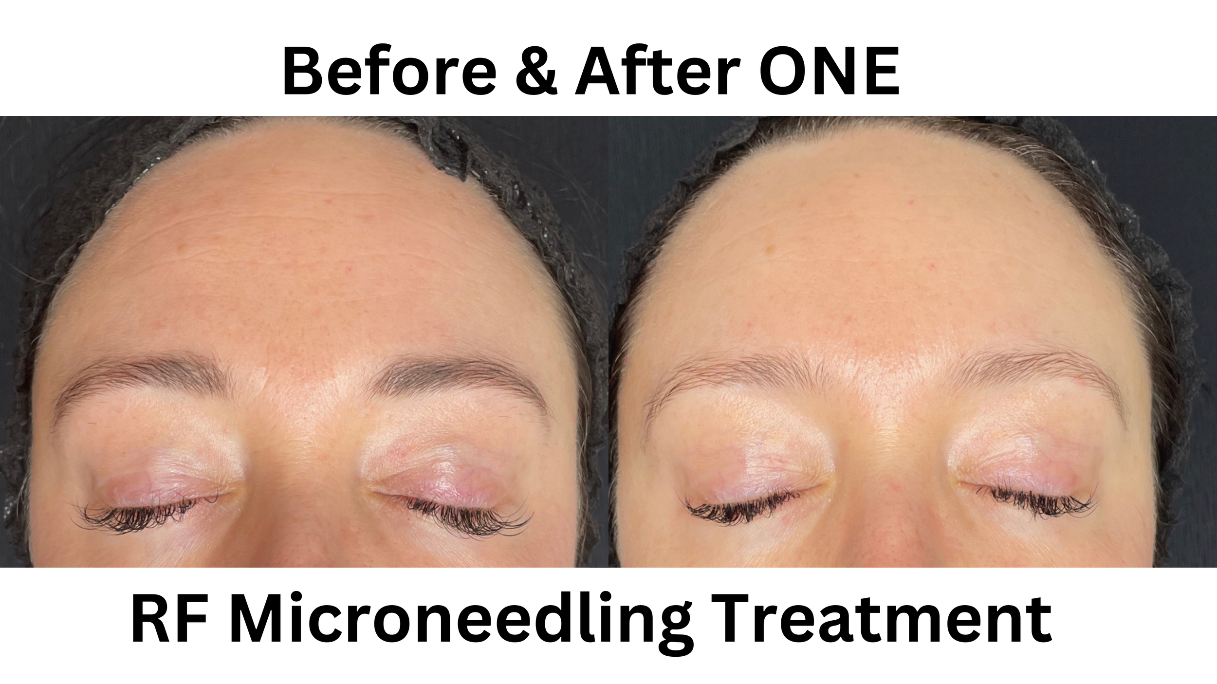 RF Microneedling — Take it Off PDX